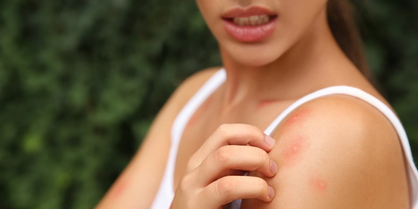 Какие бывают виды укусов разных насекомых, и как их отличить